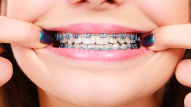 Best Braces Colors