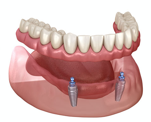 Implant Supported Dentures