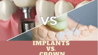 crowns or implants