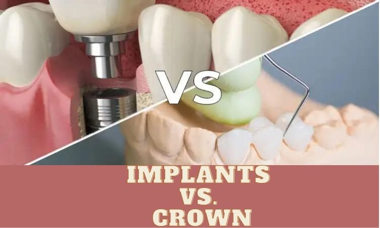 crowns or implants