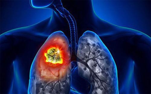 Is lung cancer curable?