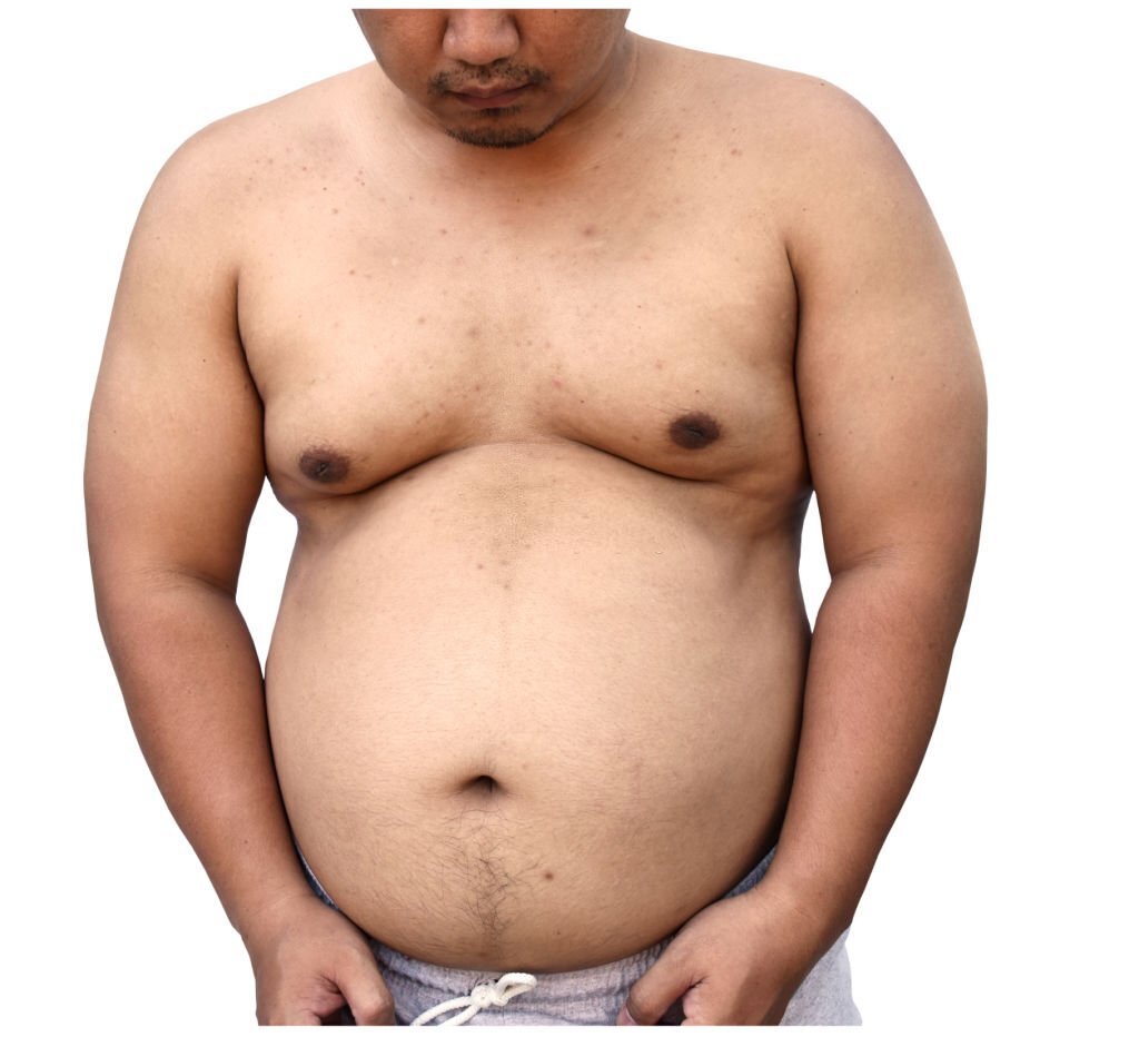 gynecomastia surgery cost